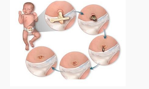 宝宝脐带护理